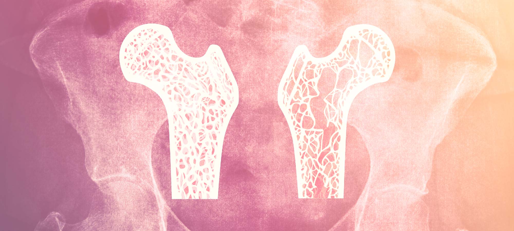 How do I know if I have osteopenia?